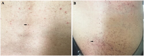 Figure 2. Skin injury. (A) Skin angiokeratoma (arrow) on the back of the proband; (B) Skin angiokeratoma (arrow) on the lower abdomen of the proband’s younger brother.