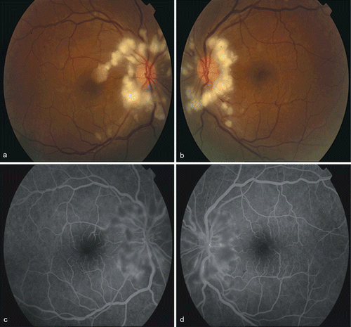 FIGURE 1  (A-B) Fundoscopic examination revealed bilateral cotton wool spots around the optic disc. (C-D) Fundus fluorescein angiography revealed hypofluorescence due to cotton wool spots without any sign of vasculitis.