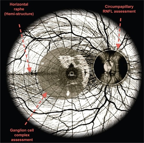 Figure 7 Ganglion cell complex measurement reflects a subset of cells different to those used for the peripapillary retinal nerve fiber layer (RNFL) assessment.