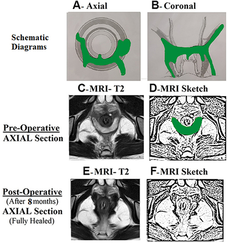 Figure 4 A 19-year-old male patient with acute posterior horseshoe abscess.