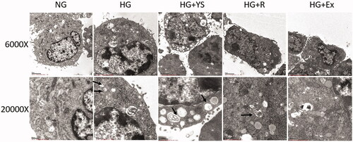 Figure 9. Representative transmission electron microscopic (TEM) images of podocytes under different culture conditions. NG = normal glucose, HG = high glucose, YS = Yishen capsule, R = resveratrol, and Ex = Ex-527. More autophagosomes are present in the HG treatment groups (i.e. HG, HG + Y, HG + R, and HG + E). Autophagosomes and vacuoles are increased in HG + Y and HG + R compared to that in the HG + E group. Images were captured at 6000 × (upper) and 20000 × (lower) magnification, respectively, with a transmission electron microscope. Black arrows indicate autophagosomes.