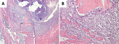 Figure 3. Histology images of allogenic bone fragments in muscle pouch (A 4×; B 20×). A granuloma, dominated by inflammatory cells, could be seen adjacent to the allogenic bone fragments. Osteocyte lacunae were empty in the fragments and no cartilage or bone formation could be seen.