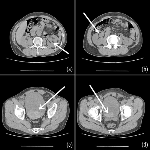 Figure 1 (a) Left hydronephrosis (white arrow); (b) Right hydronephrosis (white arrow); (c) Bladder blood clot tamponade (white arrow); (d) Bladder blood clot tamponade and median lobe of prostate was not protruded to the bladder (white arrow).
