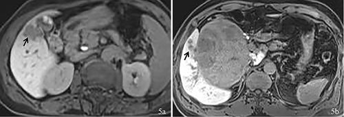Figure 5 Representative MRI features associated with recurrence-free survival. HBP images (a) for a 60-year-old female patient showing an irregularly hypointense tumor (arrow) but without peritumoral HBP hypointensity or a satellite nodule. Tumor recurrence has not been found after 28 months of follow-up. HBP images (b) for a 50-year-old male patient showing multiple satellite nodules (arrow) around the tumor without peritumoral HBP hypointensity. Tumor recurrence was detected 4 months after curative resection.