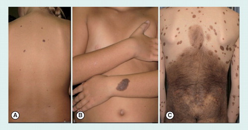 Figure 5. Congenital melanocytic nevi.(A) Small (<1.5 cm diameter) congenital nevi on the back of an 8-year-old girl. (B) Medium size (1.5–20 cm) congenital nevus on the arm of an 8-year-old girl. (C) Giant congenital nevus (>20 cm), involving the area of the buttocks and the back, in a 9-year-old boy. Of note, the presence of multiple satellite nevi can be noticed.