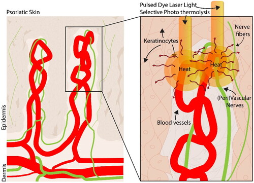 Figure 3. Illustration of heat diffusion of pulsed dye laser light from the blood vessels where the chromophore oxyhemoglobin resides toward the surrounding areas. These could include the (peri)vascular nerves, free nerve fiber endings, and keratinocytes.