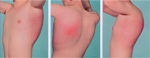 Figure 1. Acute presentation of FOP showing a diffuse posterior chest wall swelling.