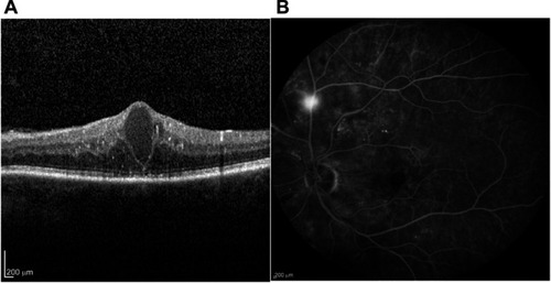 Figure 1 (A) SD-OCT scan of the left eye using spectralis -Heidelberg OCT module of the patient at presentation (B) Fluorescence angiography of the same eye using the same device (spectralis- Heidelberg) at presentation.
