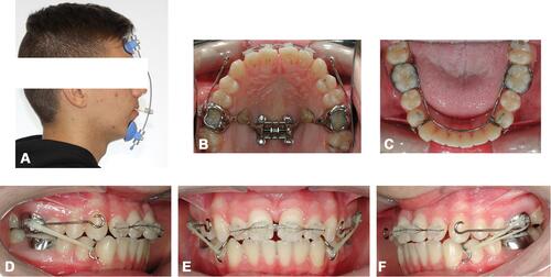 Figure 9 Maxillary protraction with facemask at night-time (A) and with intraoral elastics from a modified lingual arch to maxillary molar bands (B–F) during day-time.