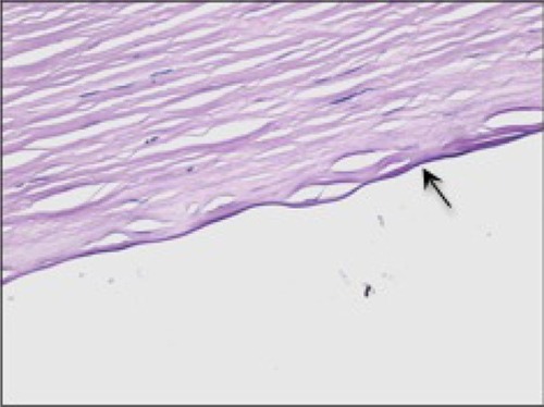 Figure 1 Microscopy of host cornea showing the presence of a thin but distinct Descemet’s membrane (arrow). The specimen was stained with periodic acid-Schiff.
