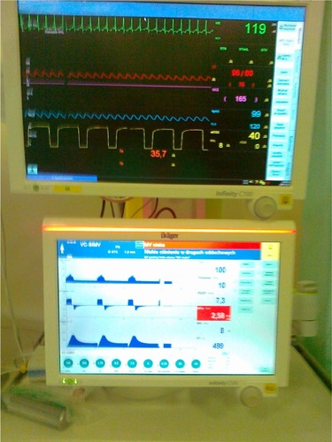 Figure 4 Picture of monitors – at the start of apneic test achieved EtCO2 was 40 mmHg, but in blood gasometry PaCO2 was 74 mmHg.