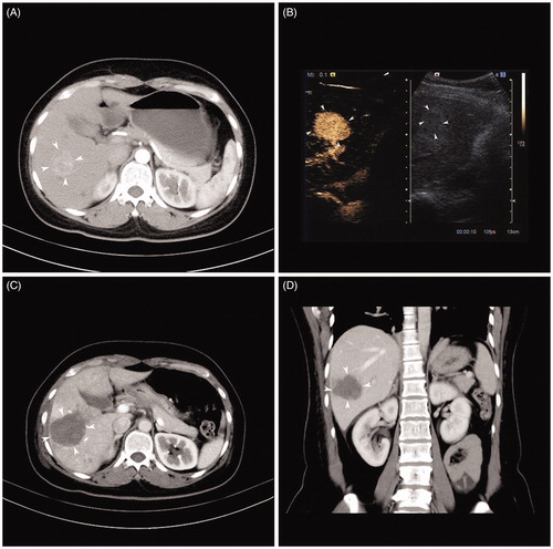 Figure 1. Representative case showing the usefulness of the MESS RFA in ablating a large volume at one time. (A) Image before MESS-RFA showing a 3.5-cm nodule with enhancement in the arterial phase. (B) Intra-procedural contrast enhanced ultrasound guiding tumour (arrowheads) targeting and monitoring. (C) Axial CT image immediately after MESS-RFA showing that the ablation zone (arrowheads) covers the index tumour (5.5 cm in size). (D) Coronal CT image reconstructed from the immediate post-procedural CT scan shows that the ablation zone (arrowheads) measures 5.4 cm in its coronal long axis.