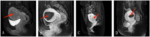 Figure 3. HIFU treatment for internal and external adenomyosis. (A) Pre-HIFU enhanced MRI showed an internal adenomyotic lesion located at the anterior wall of the uterus(arrow); (B) A contrast enhanced MR image obtained 1 day after HIFU showed the internal adenomyotic lesion was ablated(arrow). The NPV ratio was 89.5 %. (C) Pre-HIFU enhanced MRI showed an external adenomyotic lesion located at the posterior wall of the uterus(arrow); (D) A contrast enhanced MR image obtained 1 day after HIFU showed the external adenomyotic lesion was ablated without damaging to the serosa of the uterus(arrow). The NPV ratio was 44.1%.