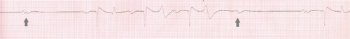 Figure 3 Electrocardiogram recorded from a horse with advanced second-degree atrioventricular block.