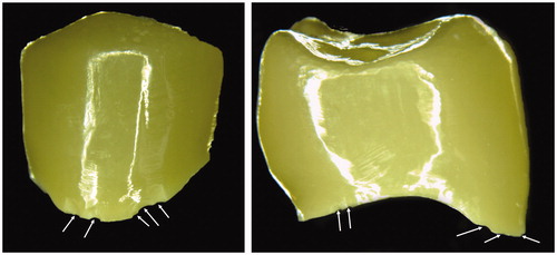 Figure 1. Two examples of ultra-translucent monolithic zirconia crowns delivered from a dental technician with multiple margin flaws (white arrows). These flaws were considered to be due to poor packaging during shipment.