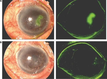 Figure 4 A) An 80-year-old male with geographic epithelial keratitis stained with fluorescein, and B) one week after treatment with ganciclovir 0.15% ophthalmic gel showing healing and re-epithelialization of the cornea.