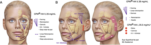 Figure 3 Step 3: Walls (Fat pad repositioning). Deep and superficial fat pad treatment: entry points, products, volumes, and technique. (A) Step 3A; Deep compartments should be approached first; (B) Step 3B; if needed, superficial fat compartment injection can be performed thereafter. *The use of CPM®-HA 1, 25.5 mg/mL is the author’s choice due to it’s projection capacity. The injection, instead, of CPM®-HA V, 26 mg/mL is also a good option. (Image partially reproduced from Merz Institute Advanced Aesthetics platform-www.merz-institute.com).