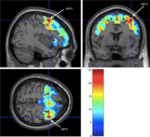 Figure 1 Greatest activation was observed in right middle frontal gyrus (x=38, y=6, z=56), significant at P<0.05 (corrected for FWE) during N-back task among participants with mild cognitive impairment.