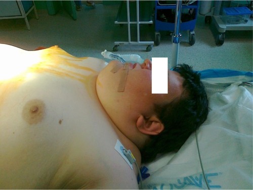 Figure 1 Airway evaluation of the patient revealed increased neck circumflex (>46 cm) and reduced neck mobility, which, together with a history of diabetes mellitus type 2, indicated possible difficult intubation.