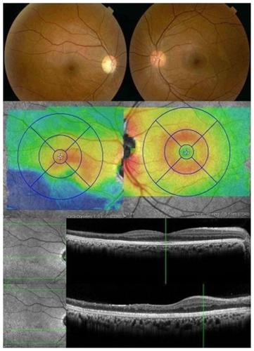 Figure 4 Retinal thickness map and raster scans confirming normal thickness at fovea but thinning of the inner retinal layers in the infero-temporal retina due to a long standing branch artery occlusion in the right eye (Case 4).