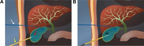 Figure 1 The schematic representation of percutaneous cholecystostomy combined with choledochoscope procedures.