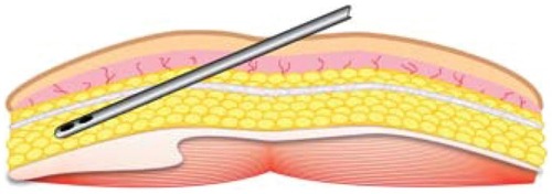 Figure 11 Placement of microcannula below Scarpa’s fascia in the adipose tissue plane.