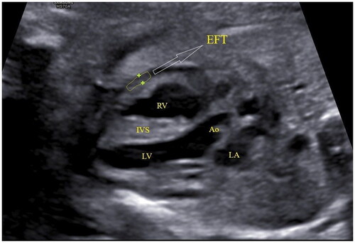 Figure 2. Ultrasonographic image of fetal epicardial fat tissue. EFT: epicardial fat thickness; RV: right ventricle; LV: left ventricle; IVS: interventricular septum; Ao: ascending aorta; LA: left atrium.