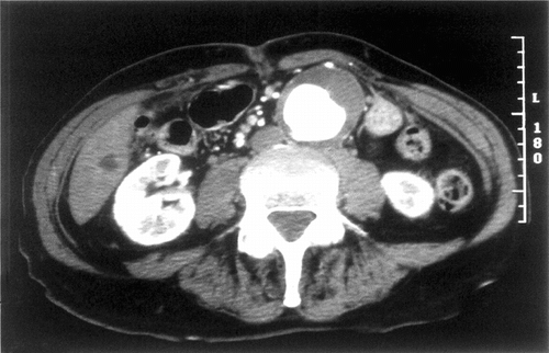 Figure 2 CT scan illustrating the infra-renal abdominal aorta aneurysm of the 75 y.o. patient prior to the stent-graft deployment. The diameter of the aneurysm was 5.7 cm.