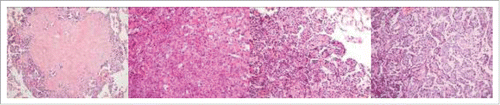 Figure 2. The tumor showed the typical histological features of PSP, with varied proportions of sclerotic (A), solid (B and C) and papillary (C and D) patterns.