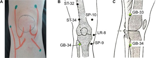 Figure 1 Points of periarticular injection around the knee (blue dots) and articular nerves of the left knee (red lines).