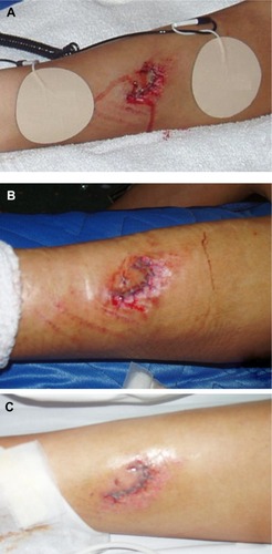 Figure 2 Rapid recovery from a serious wound with minimal swelling and redness expected for such a serious injury.Notes: Cyclist was injured in Tour de France competition – chain wheel gouged his leg. (A) Grounding patches were placed above and below wound as soon as possible after injury. Photo courtesy of Dr Jeff Spencer. (B) Day 1 after injury. (C) Day 2 after injury. There was minimal redness, pain, and swelling, and cyclist was able to continue the race on the day following the injury. (B and C) Copyright © 2014. Reprinted with permission from Basic Health Publications, Inc. Ober CA, Sinatra ST, Zucker M. Earthing: The Most Important Health Discovery Ever? 2nd ed. Laguna Beach: Basic Health Publications; 2014.Citation1