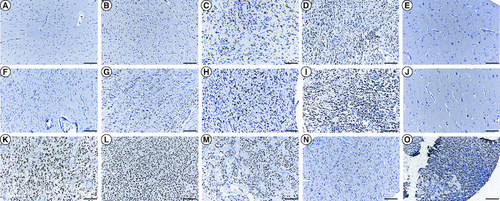 Figure 2. Immunocytochemical analysis of PRAMEF12 protein expression in glioma and adjacent normal tissues on a tissue microarray slide.Immunohistochemical staining of (A–D) astrocytoma tissues, (F–I) glioblastoma tissues, (K) not otherwise specified, (L) oligodendroglioma, (M) ependymoma, (N) ganglioglioma, (O) gliosarcoma and (E & J) the adjacent normal tissues showed a sharp contrast between expression in the normal and tumorous areas. (A & F) Staining score 0: no nuclear staining of tumor cells. (B & G) Staining score 1+: ≤30% nuclear staining of tumor cells. (C & H) Staining score 2+: 31–60% positive nuclear staining. (D & I) Staining score 3+: 61–100% positive nuclear staining. (E & J) Negative PRAMEF12 staining. Scale bar = 50 μm.