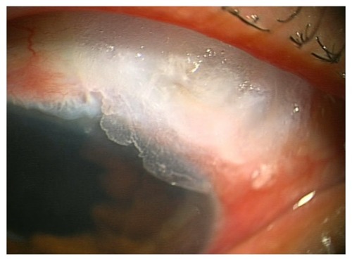Figure 3 Patient 4, a 45-year-old woman. 2-Octyl-cyanoacrylate was secured on an avascular bleb leak.