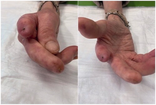 Figure 2. Healing process at 6 months: detail of II and III fingers of the right hand 6 months after injection of autologous adipose cells.
