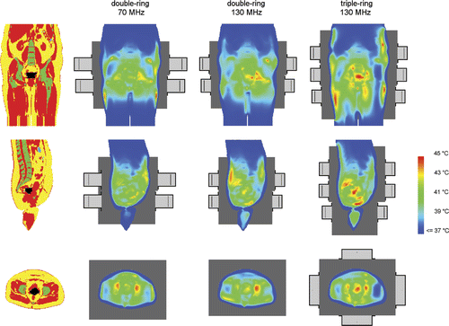 Figure 7. Coronal (top), sagittal (centre) and transversal (bottom) slices of the anatomy of patient 1 (left column). Red corresponds to muscle tissue, fat tissue is yellow, bone is green and inner air is blue. The tumour is represented by the black spot in the centre. The other three columns show the temperature distributions optimised for double-ring systems at 70 and 130 MHz and a three-ring system at 130 MHz. Left and right of the patient correspond with right and left in these pictures, respectively. The orthogonal slices run through the centre of gravity of the tumour.