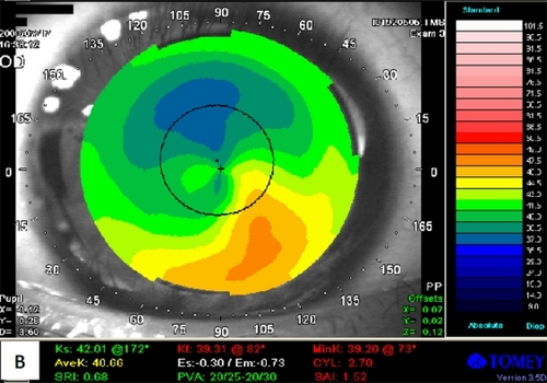 Figure 1-B Patient 1: TMS with inferior steeping after two years of LASIK.