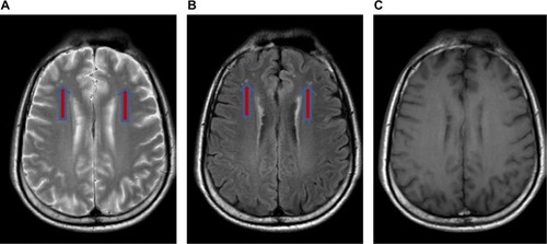 Figure 2 Magnetic resonance imaging of the brain showed small round multiple hyperintense lesions at bifrontal lobes on T2-weighted (A) and fluid-attenuated inversion recovery images (B) (red arrows). The lesions were not seen on T1-weighted image (C)