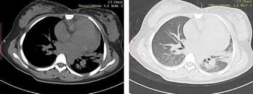Figure 1 Chest CT images of the patient on the 3rd day of admission showed enlarged heart shadow, pericardial effusion, ground-glass opacity and patchy consolidation as well as thickened bronchovascular bundle in bilateral lung.