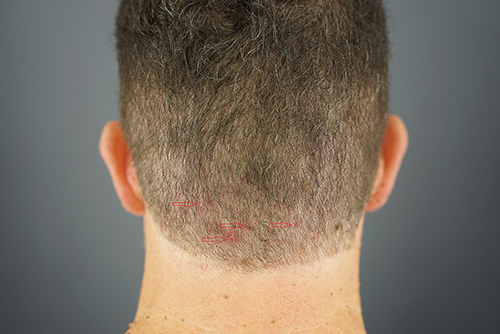 Figure 6 A European-descended White male showing scattered erythematous papules (Red arrows) in the nape area found to be AKN upon histologic analysis.