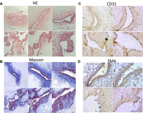 Figure 1 Gross morphology of the normal external jugular vein (EJV) and the arterialized EJV showed by HE staining (A) and Masson staining (B). We observed vascular dilatation, thin wall, discontinuous and irregular intima, incomplete elastic layer, dysplasia of the medial membrane, disordered smooth muscle arrangement, increased collagen fibers and smooth muscle protruding into the lumen of AV. The discontinuity of AV’s endothelial cells was shown based on CD31 staining (C), and the changes of AV’s smooth muscle such as hyperplasia, disordered and protruding into the lumen were shown based on SMA staining (D) (original magnification, A, X10 (upper panel), X20 (lower panel), B X4, X10, X20 (from left to right), C, D X20, X40 (from left to right)).