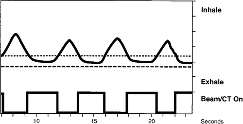 Figure 1.  A respiratory signal obtained from the RPM™ system (Varian Medical Systems, Inc) showing the vertical motion of an optical marker placed on a patient's chest wall versus time. Two horizontal lines overlayed on the breathing curve indicate a chosen gating window in the expiration phase of breathing, and below a step curve indicates beam on and off times.