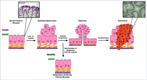 Figure 1. Preventing colorectal cancer by exploiting the paracrine hormone hypothesis of colorectal cancer. Colorectal cancer is a stepwise disease whereby a normal epithelium is transformed over a period of years into first an adenoma until finally becoming an adenocarcinoma. Importantly, guanylin expression is lost early and universally in this transformative continuum and contributes to disease progression as depicted in the diagram. Insets to this cartoon show adapted immunohistochemistry images (guanylin depicted in purple, nuclei/hematoxylin depicted in black) of normal human colonic epithelium as contrasted with human adenocarcinoma which demonstrate complete loss of guanylin staining in the adenocarcinoma (inset images adapted from Wilson etal. Biomarkers & Prevention, 2014). Importantly, GUCY2C ligand loss in colorectal cancer provides a therapeutic opportunity for chemoprevention through exogenous administration of GUCY2C ligands.