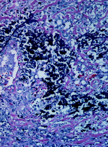 Figure 1-4.  Histological features of the lesions showing osteoid (light pink) and bony trabeculae surrounded by malignant tumor cells, from patient 1, 2, 3 and 4 respectively. In patient 1 and 4 areas of calcification are also seen. (Hematoxylin and eosin; magnification x400.)