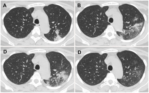 Figure 5 Chest CT images of a 29-year-old perinatal female with COVID-19 pneumonia, presenting post-partum fever for 1 day. (A) Day 1 after symptom onset, pure consolidation was located peripherally in the left upper lobe. (B) Day 7, the lesion progressed with increased extent and heterogeneous density. (C) Day 11, the lesion further progressed with increased consolidation component. (D) Day 18, lesions were dissipated into ground-glass opacity and few irregular linear opacities.