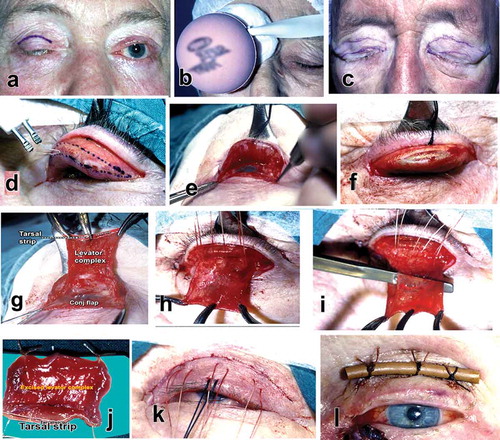 Figure 2. Composite image of several patients’ intra-operative steps for enhanced understanding. (a) Skin marking for lid fold; (b) gentle orbital compression after LA, 30 min pre-op; (c) resulting orbital decongestion – in a patient needing blepharoplasty and simultaneous MT flap resection; (d) cautery applied along dotted lines; (e) created conjunctival flap; (f) along line x-x' having created the tarsal groove with # 15 blade, the centre 4mm of the groove is perforated by the heel of the blade, and Vannas scissors are insinuated in the button holed tarsus cutting along the entire Groove to create the tarsal strip of the MT flap, which then is mobilised by cutting the medial and lateral horns of the levator aponeurosis; (g) mobilised MT flap, conjunctival flap protecting cornea, and ocular surface; (h) three double armed mattress sutures coapting conjunctival flap and levator; (i) evidence that MT flap contains levator and Müller muscles, shown separated by scalpel handle; (j) resected 18+ mm MT flap; (k) sutured blepahoplasty of (c), white silk sutures surfaced as per L-mnemonic; and (l) rubber bolster at first dressing.With acknowledgements to PostScript Media Pvt Ltd.