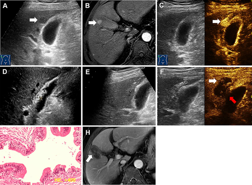 Figure 3 A 65-year-old male with cholelithiasis who was planned to undergo LC after RFA. (A–C) Conventional ultrasound and contrast-enhanced ultrasound (CEUS), and contrast-enhanced MR image showed a HCC (15×10 mm) in segment V abutting to the gallbladder (white arrow). Before ablation, the thickness of the gallbladder wall was 4 mm. (D) Sediment-like gallstones (white cross) were found on ultrasound images. (E) The electrode was inserted parallel to the gallbladder wall with a distance less than 5 mm (white cross). (F) CEUS showed that the index tumor had been completely ablated (white arrow) while the perfusion defect of the gallbladder wall was found by accident (red arrow). Patient underwent LC soon after RFA procedure, thermal damage of the gallbladder wall was found in postoperative specimens. (G) Postoperative pathology confirmed the thermal damage of the serosa and mucosa of the GB wall. (H) CEMR one month after the RFA procedure confirmed the technical efficacy (white arrow).