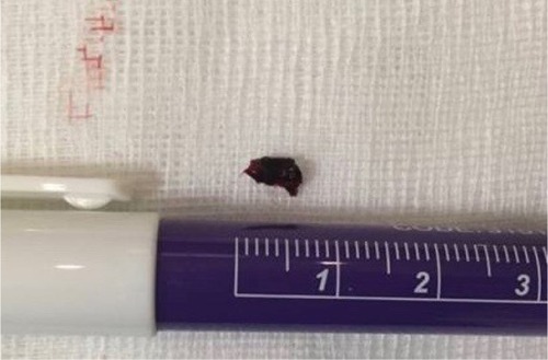 Figure 3 The 6 mm red clot removed from left middle cerebral artery following endovascular thrombectomy.