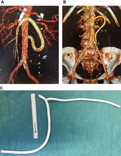 Figure 3 (A). 3D reconstruction of a laparoscopic retrograde aorto-mesenteric bypass to the superior mesenteric artery (yellow arrow). Occluded stent in the superior mesenteric artery (green arrow). (B): 3D reconstruction of a laparoscopic retrograde aorto-mesenteric bypass to the superior mesenteric artery (blue arrow), from the left graft limb of a prior laparoscopic aortobifemoral bypass graft (red arrow). (C): A 6 mm expanded polytetrafluoroethylene graft, end-to-side anastomosed to an 8 mm ring enforced expanded polytetrafluoroethylene graft with graduated length markings and spatulated end.