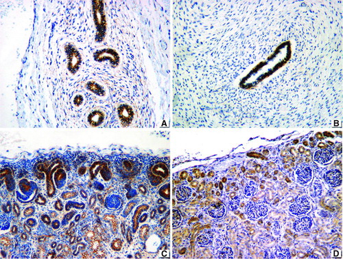 FIGURE 5  Beta-catenin panel. (A) Membranous staining in dysplastic tubular epithelium of a case with obstructive MCDK. (B) Same pattern in a patient with nonobstructive MCDK. (C) Overexpression in nephrogenic zone of fetal kidney. (D) Positive reaction in normal tubular epithelium of control. 76 × 57 mm.