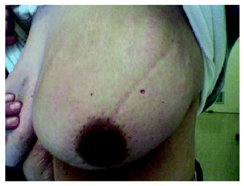 Figure 4. Complete resolution of the skin involvement after chemotherapy.